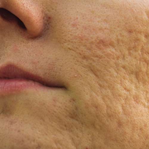 Acne Scars Treatment In Lahore at Institute Cosmetique.