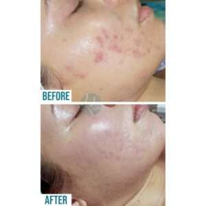 Acne Scars Treatment In Lahore, Pakistan at Institute Cosmetique.