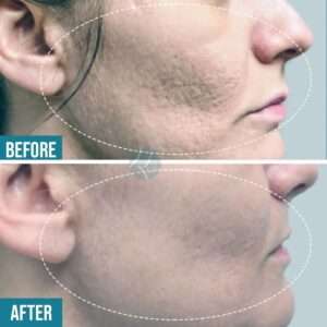 Before & After Of Acne Scars In Lahore