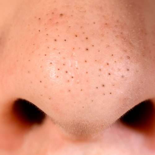 Black Heads Treatment In Lahore, Pakistan