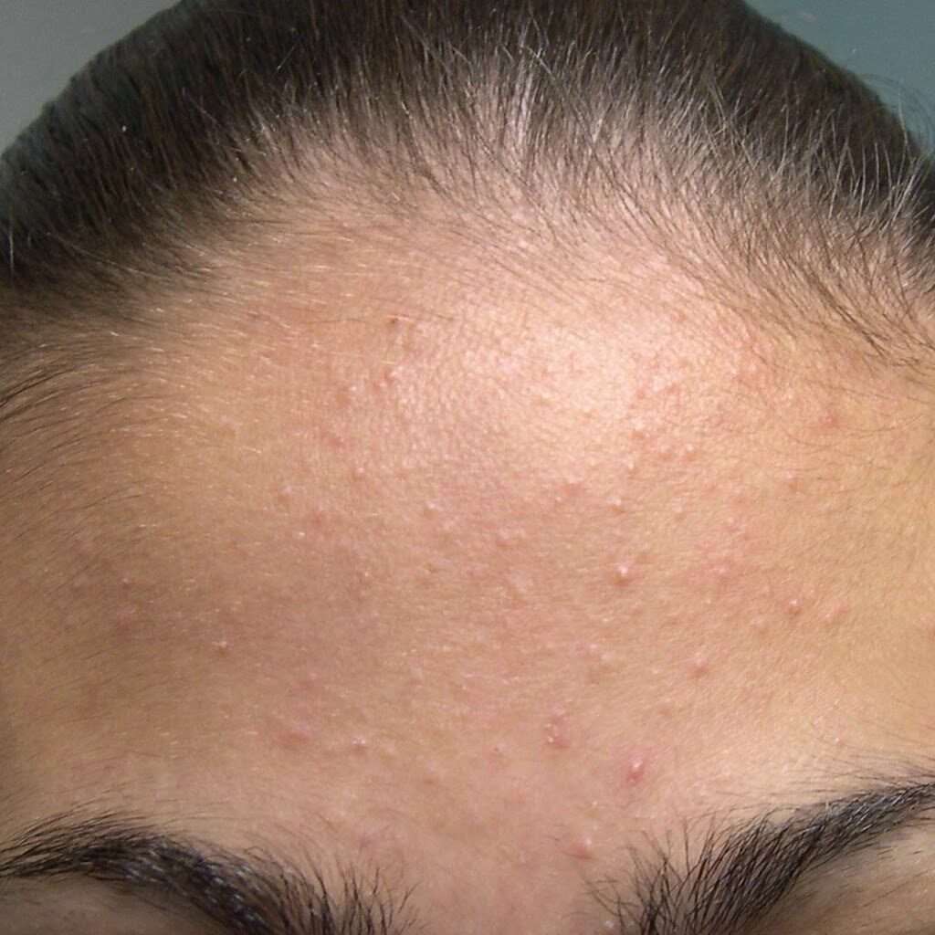Comedones (Acne) Treatment In Lahore, Pakistan At Institute Cosmetique.