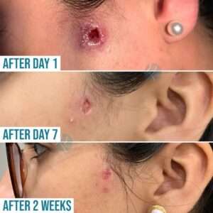Cyst Treatment In Lahore, Pakistan at Institute Cosmetique