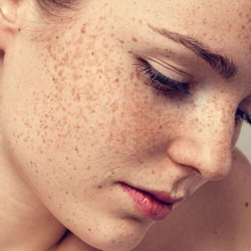 Hyperpigmentation Treatment In Lahore, Pakistan