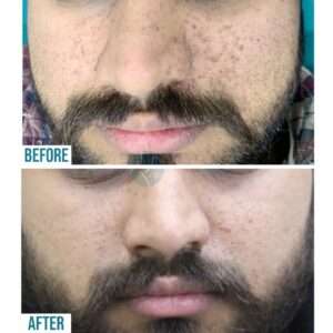 Hyperpigmentation Treatment In Lahore, Pakistan