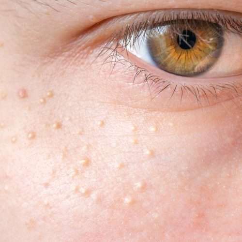 White Heads Treatment In Lahore, Pakistan